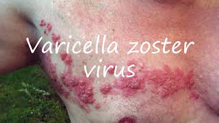 How to Pronounce Varicella zoster virus [upl. by Lenra]