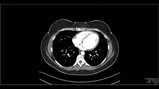 Abdominal Anatomy on Computed Tomography [upl. by Nadnerb]