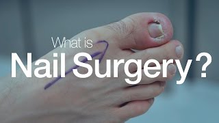 What is Nail Surgery [upl. by Dorej]