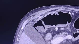 Peritoneal metastases in CT [upl. by Namya206]