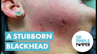 Dr Pimple Popper Helps With Blackhead Cyst [upl. by Nairred]