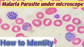 malaria parasite under microscope  P vivax malaria  malaria parasite blood smear [upl. by Ehtylb]