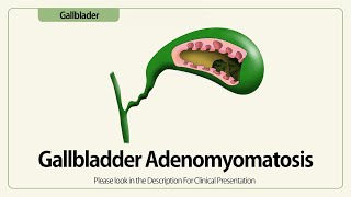 Linear EUS Gallbladder Adenomyomatosis [upl. by Cyrus857]