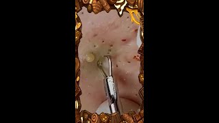 Blackheads Removal  Acne Treatment and Very Satisfying Satisfying Pimple pop blackheads [upl. by Annaitsirk365]