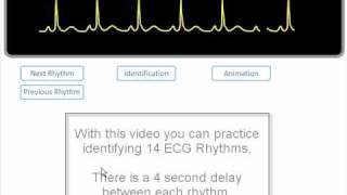 ECG Rhythm Review of 14 common rhythms [upl. by Richart310]