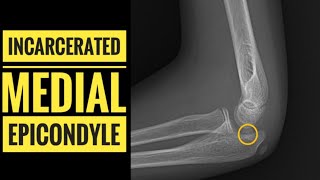 Incarcerated Medial EpicondyleHow to Diagnose [upl. by Asiled886]