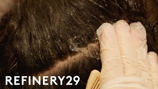 🔥1 Dandruff Treatment at Home  How to get rid of Dandruff  Dandruff Removal  Itchy scalp [upl. by Odnalor]