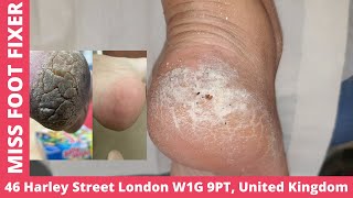 satisfying cracked heel removal by miss foot fixer [upl. by Kerred500]