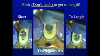 Endodontic Pecking Motion [upl. by Peisch]