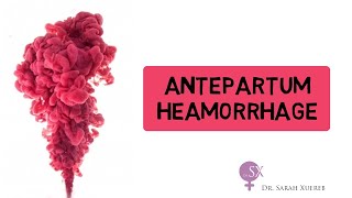 Antepartum Haemorrhage [upl. by Suiradel]