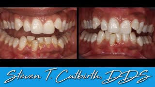 Scaling and Root Planing  Dental Minute with Steven T Cutbirth DDS [upl. by Onaicul]