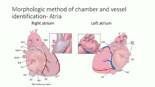 第3回小児webinar Segmental approach to congenital heart disease 佐々木 奈央 [upl. by Eiznikam]