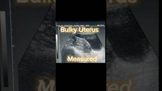 Bulky Uterus  Heterogenous Variable Texture of Uterus  Ovarian Cysts  Adnexa Cyst on Ultrasound [upl. by Arratoon]