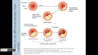 Angina Pathophysiology amp Treatment overview [upl. by Justus880]