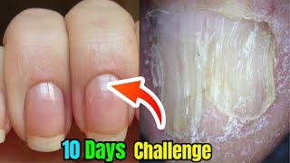 Brittle Nail Syndrome Signs Symptoms And Its Treatment [upl. by Faires92]