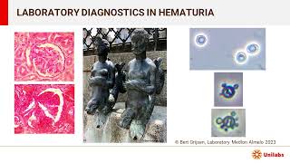 Laboratory Diagnostics in Hematuria blood in urine [upl. by Dorry]