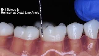 Periodontal Probe Basic Technique [upl. by Leinahtan918]