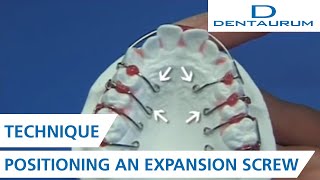 Positioning an expansion screw on the model for orthodontic appliance [upl. by Nomal]