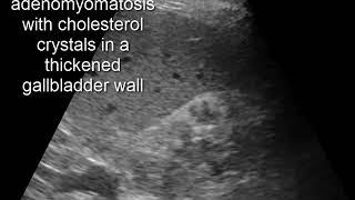 CASE 320 adenomyomatosis with cholesterol crystals in a thickened gallbladder wall [upl. by Harriman111]