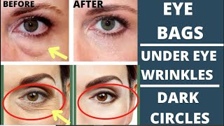 ANTIAGING FACE EXERCISES FOR EYE BAGS EYE WRINKLES DARK CIRCLES amp TIGHTEN DROOPY EYELIDS [upl. by Benson]