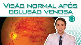 Visão normal após oclusao venosa da retina é possível [upl. by Imoian]