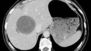 Why Liver Abscess is common on the right lobe [upl. by Clayson613]