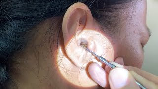 Massive Hard Dry Earwax Removed from Womans Ear [upl. by Airpac100]