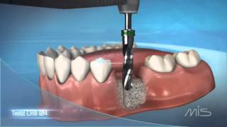 Procedimiento de colocación de implante dental MIS El Salvador [upl. by Reich947]