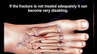 Stress Fractures Of The Metatarsal Bones  Everything You Need To Know  Dr Nabil Ebraheim [upl. by Tnert]