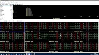 1 Introduction to Holter Analysis NEM [upl. by Peggir]