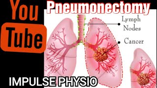 Pneumonectomy Impulse physio [upl. by Akkahs]