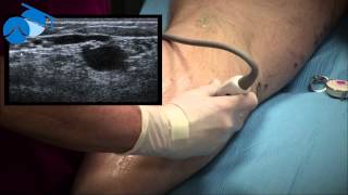 Marking of Small Saphenous Vein SSV and Incompetent Perforating Vein IPV [upl. by Juta]