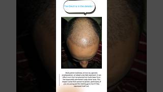 Finasteride for hair loss in androgenic alopecia [upl. by Lincoln]