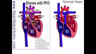 37 Shones Complex with severe coarctation of the aorta [upl. by Akihsat]