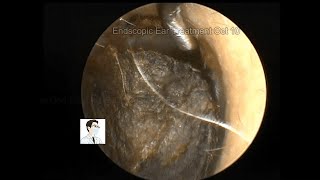 ear wax removingserious ear cerumen embolism cleaning 11mins20221010 [upl. by Ellehsat995]