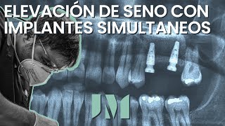 Elevación de seno maxilar con implantes simultaneos [upl. by Brennan]