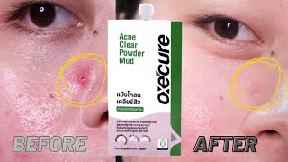 EFFECTIVE SA PIMPLES TO ONLY P8900  OXECURE Acne Clear Powder Mud [upl. by Anilemrac242]