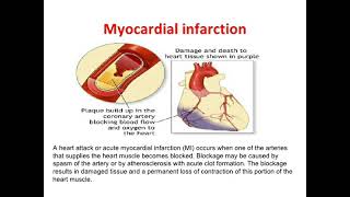 Myocardial infarction  explain  trick mona tass treatment of MI at the end of video [upl. by Eralcyram492]