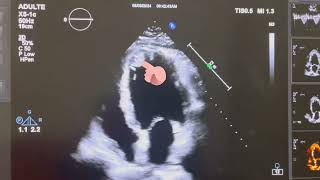 LV APICAL CLOT [upl. by Zaraf]