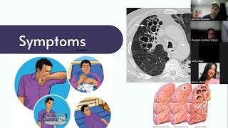 Tuberculosis  clinical features management and impact in lifetime [upl. by Dianthe708]