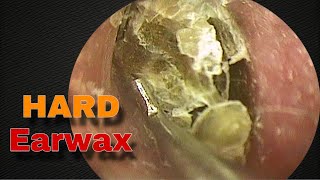 BIGGEST Earwax Removal Hard as Nails  Doctor Anh [upl. by Bhayani226]