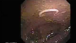 Video Colonoscopy Showing a Parasite in the Cecum [upl. by Nadler]