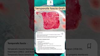 Temporalis Fascia Graft drkumargaurav doctor entsurgeon earpain lucknow Hazratganz aliganz [upl. by Noek]