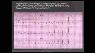 მიოკარდიუმის იშემია და წინაგულების ციმციმი miokardiumis ishemia da winagulebis cimcimi stenokardia [upl. by Irami]