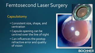 Femtosecond Laser Cataract and Refractive Lens Exchange Surgery at Bochner Eye in Toronto [upl. by Antonina]