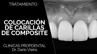 Carillas de composite en Propdental [upl. by Enegue863]