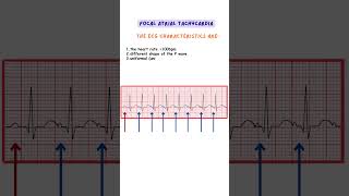 Focal Atrial Tachycardia ecg ecginterpretation medicine doctor nurse [upl. by Hock]