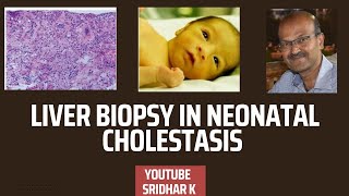 Liver biopsy to diagnose biliary atresia liverbiopsy histopathology biliaryatresia [upl. by Midge979]