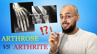 Arthrose et arthrite  les différences causes symptômes traitements [upl. by Simson]