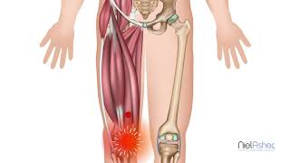 Vastus Medialis  Knee Pain  How To Find Trigger Points [upl. by Akel]